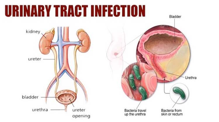 Urinary Tract Symptoms  and Homeopathic Medicines